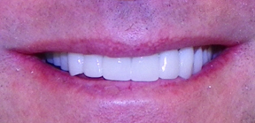 After Dental Work 1a Monmouth County NJ