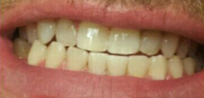 After Dental Work 3a Monmouth County NJ