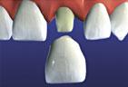 Crown Being Cemented to Tooth