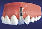 Crown Bridge Used With Implant