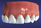 Final Tooth Implant