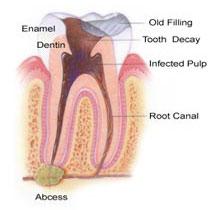 Root Canal Services Jackson New Jersey