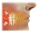 Wisdom Tooth Extraction